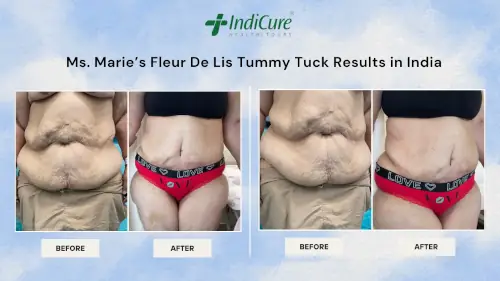 Fleur De Lis Tummy Tuck Results in India